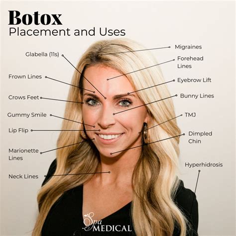 Does Botox work faster the second time?