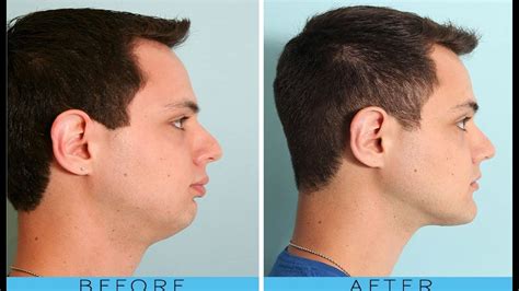 Does DHT affect jawline?