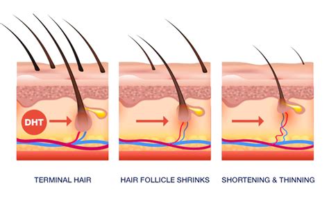Does DHT permanently damage hair follicles?