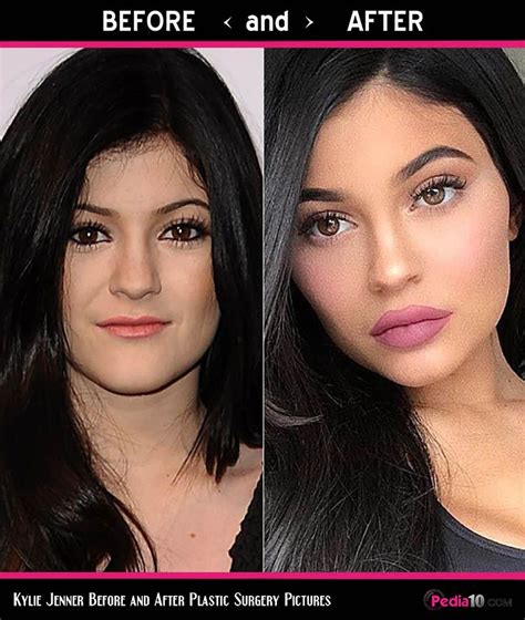 Does Kylie still use lip fillers?