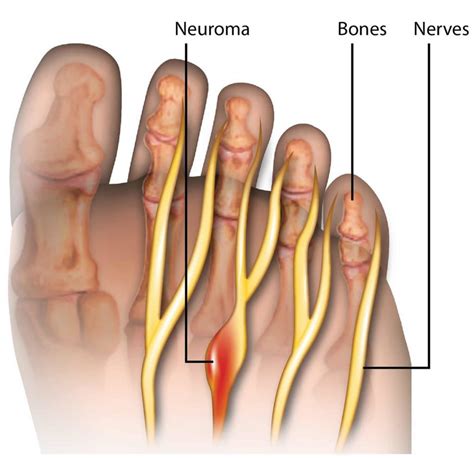Does Morton's neuroma qualify for disability?