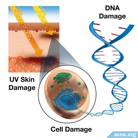 Does UVA or UVB cause melanoma?