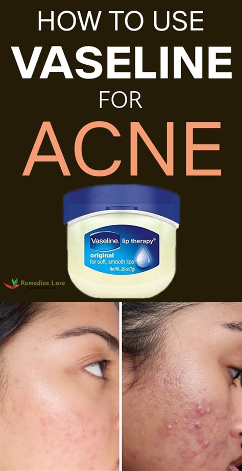 Does Vaseline help acne?