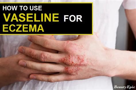 Does Vaseline help eczema?
