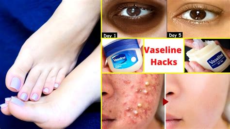 Does Vaseline help rashes?