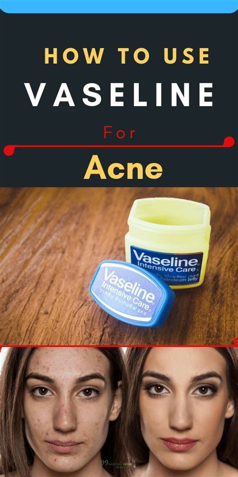 Does Vaseline help scars go away?