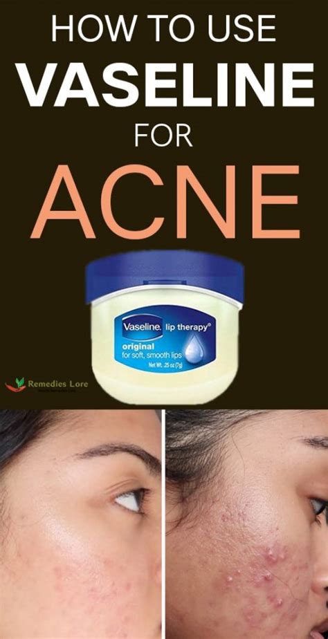 Does Vaseline help with acne overnight?