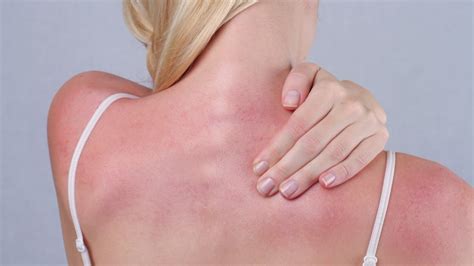 Does Vaseline help with sunburns?