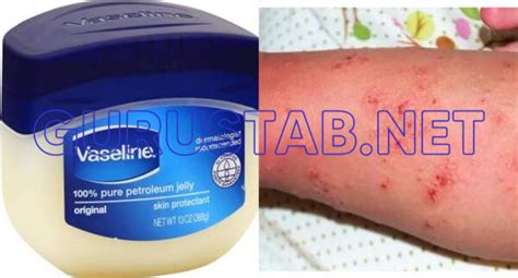 Does Vaseline kill mites?