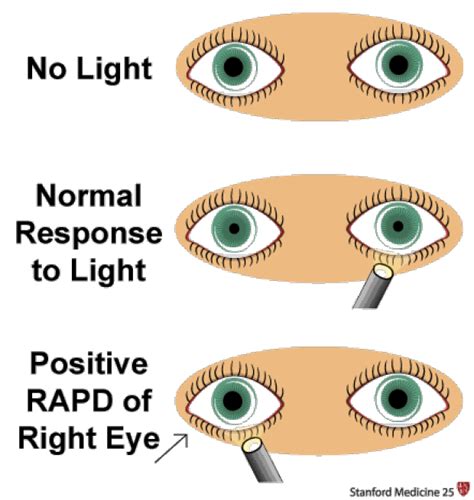 Does a blind person's pupils react to light?