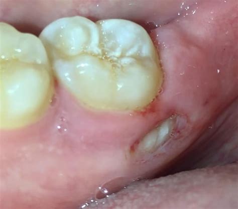 Does a bone spur in gum hurt?