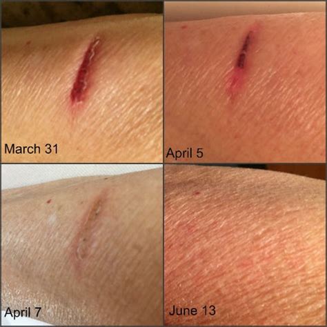 Does a burn mark count as a scar?