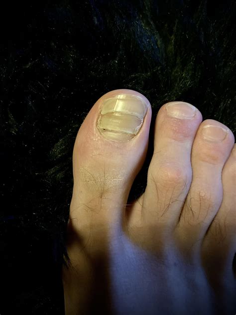 Does a dead toenail still grow?