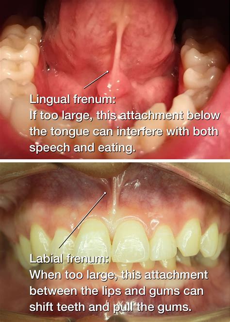 Does a frenectomy change your speech?