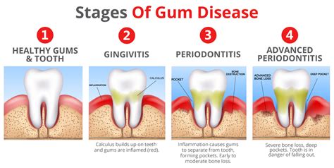 Does a gum infection get worse before it gets better?