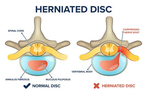 Does a herniated disc hurt all the time?