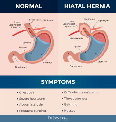 Does a hiatal hernia feel like food is stuck?