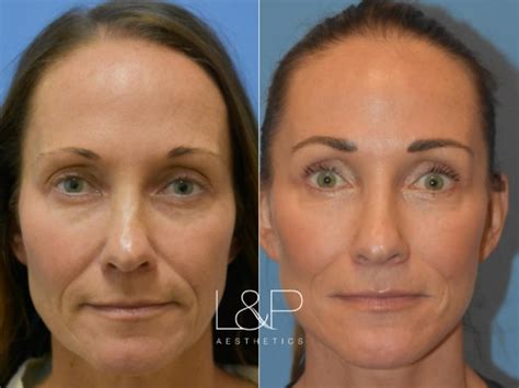 Does a neck lift make you look younger?