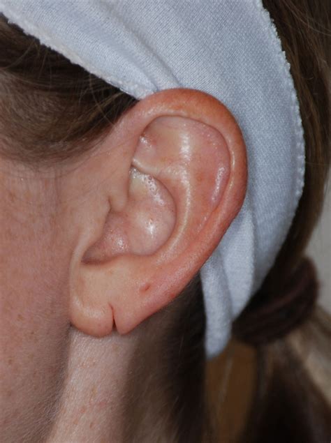 Does a torn earlobe need stitches?