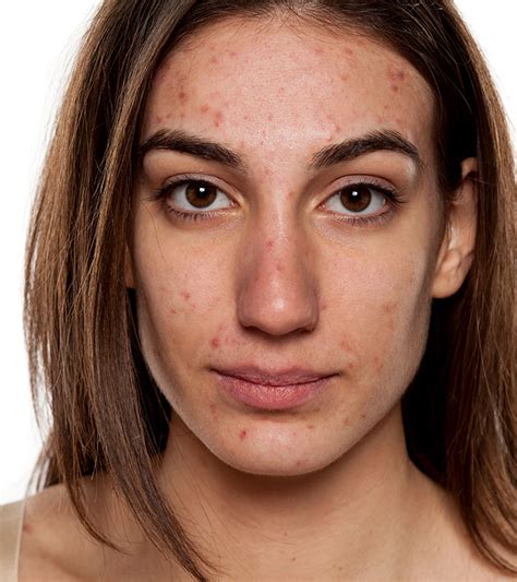 Does acne last for 10 years?