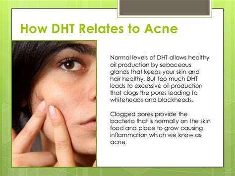 Does acne mean high DHT?