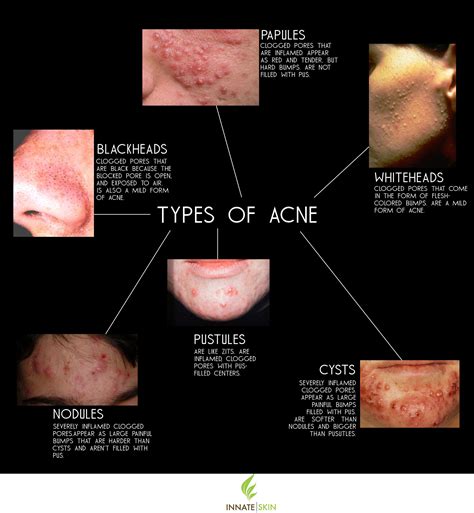 Does acne slow aging?