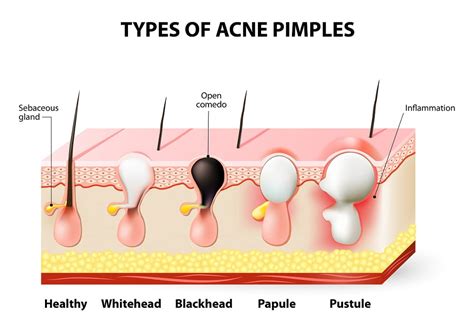 Does acne slow down at 18?