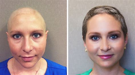 Does all chemo cause hair loss?