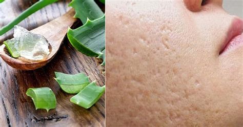 Does aloe vera close pores?