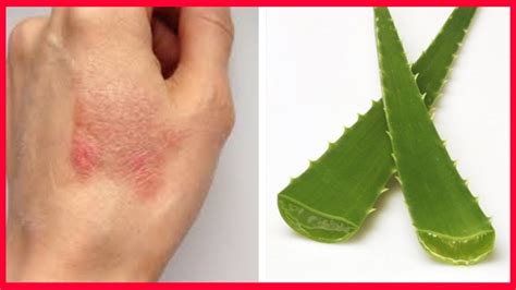 Does aloe vera remove burn marks?