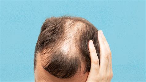 Does androgenetic alopecia cause oily hair?