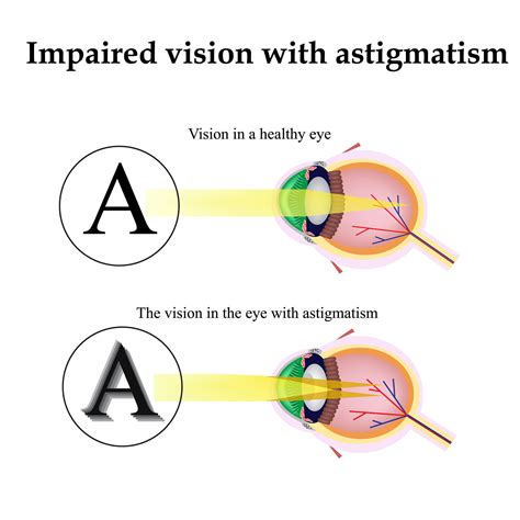 Does anti-glare help astigmatism?