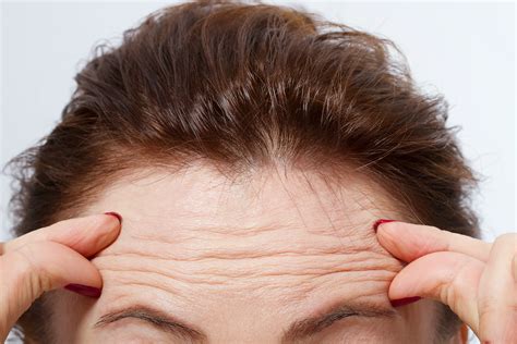 Does anything really help forehead wrinkles?