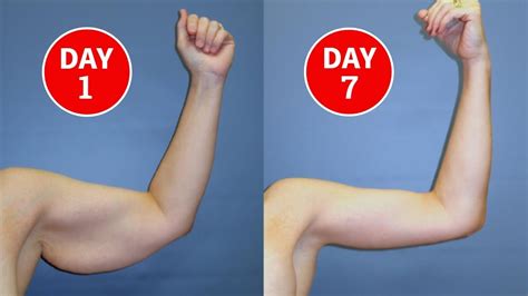 Does arm fat go away easily?