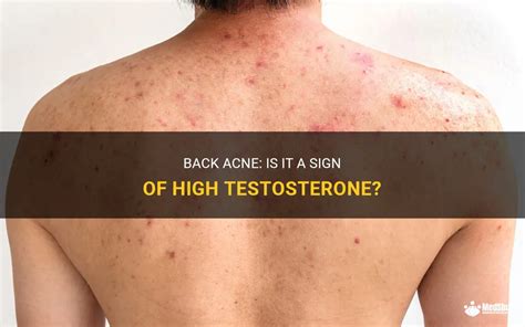 Does back acne mean high testosterone?