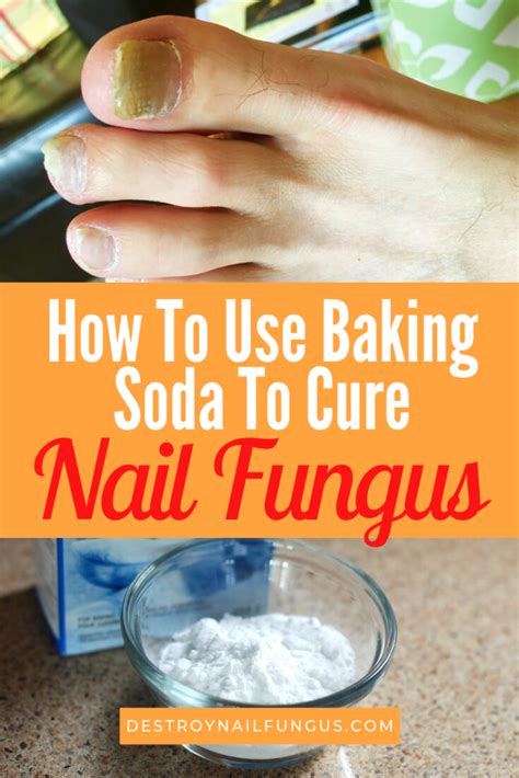 Does baking soda kill fungus?