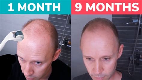 Does balding stop after 30?