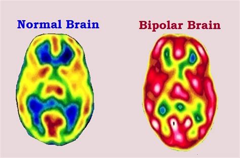 Does bipolar affect intelligence?