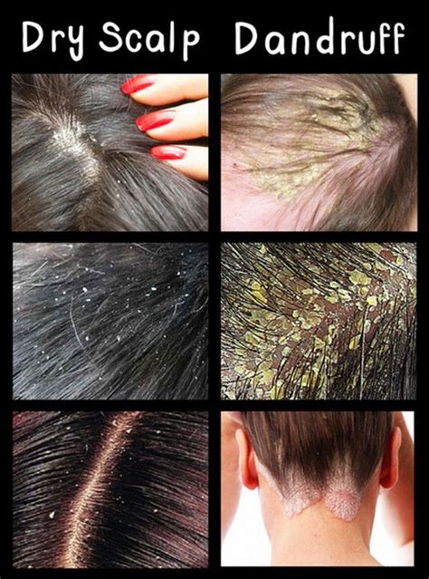 Does blowing your hair help with dandruff?