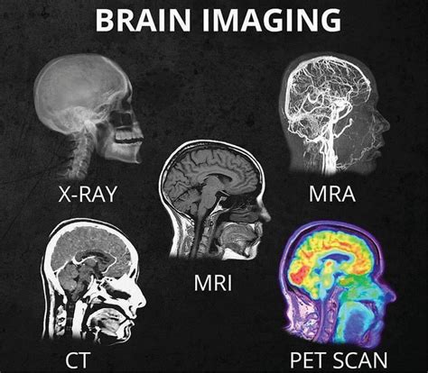 Does brain damage always show on MRI?