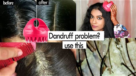 Does brushing your hair get rid of flakes?