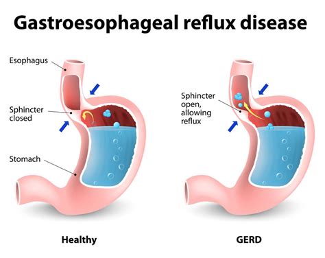 Does caffeine affect hiatal hernia?