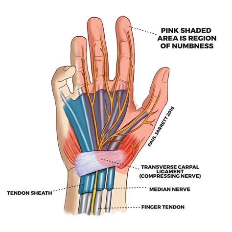 Does carpal tunnel come and go?