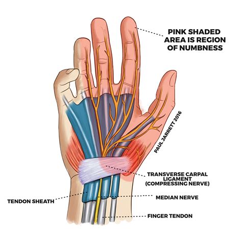 Does carpal tunnel only affect one finger?