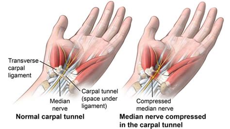 Does carpal tunnel release grow back?