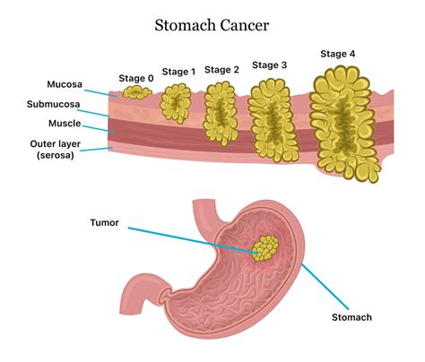 Does chemo destroy your stomach lining?