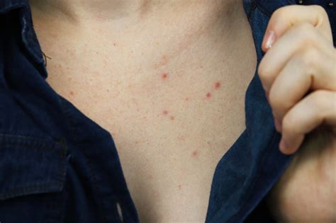 Does chest acne leave marks?
