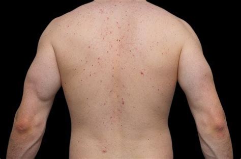 Does chest acne mean testosterone?