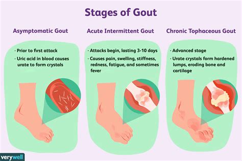 Does chocolate cause gout?