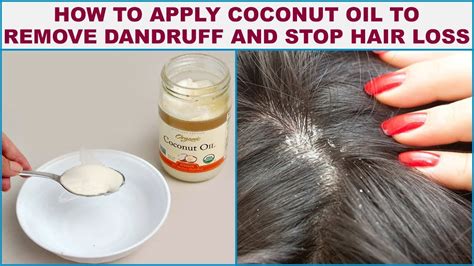 Does coconut oil kill fungus on scalp?